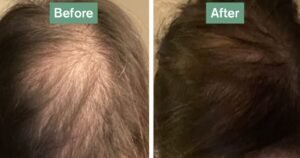 Hair growth tablets proven to give ‘big difference in weeks’