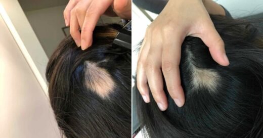 I was so stressed I had a bald patch this protein spray regrew my hair