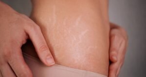 Stretch marks will be ‘far less visible’ if 1 method is followed to ‘help them fade’