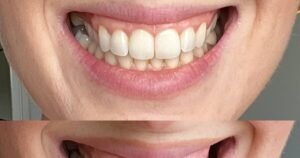 Shoppers love dentist-approved teeth whitener that ‘removes stains’