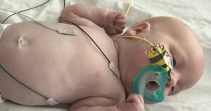 Breakthrough in gene-editing therapy helps baby with rare disorder