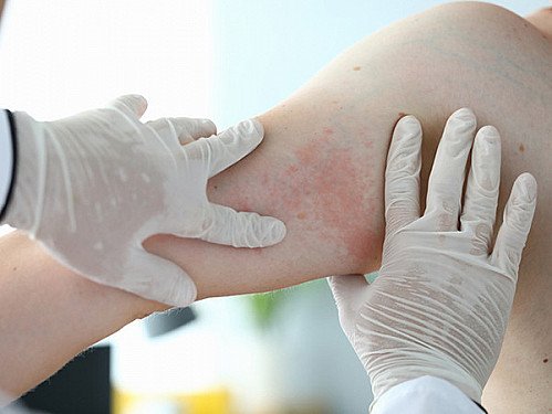When is a drug rash more than just a rash?