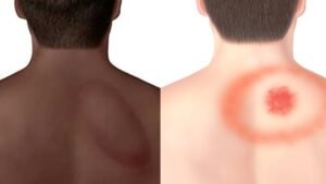 Lyme Disease Rashes | Lyme Disease