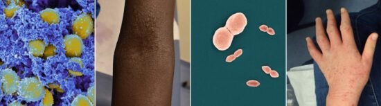 Eczema (Atopic Dermatitis) | NIAID: National Institute of Allergy and Infectious Diseases