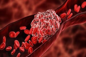 New research from Emory University may revolutionize how stroke, heart attack, related blood-clotting conditions are treated