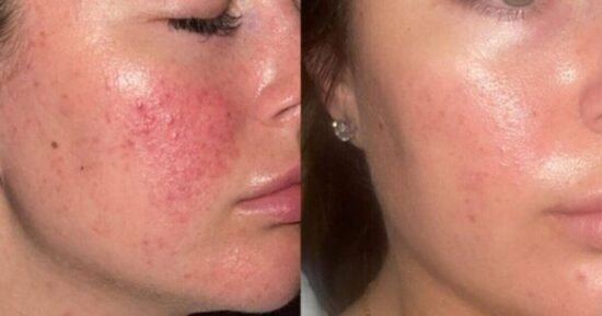 Teens ‘more confident’ after ‘life-changing’ blemish-busting skincare