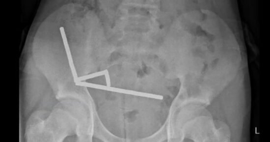 Boy who swallowed 100 magnets has surgery to remove them from his gut