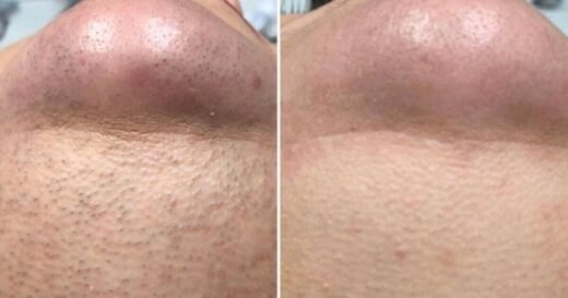 Shoppers ‘unwanted neck hairs fully gone’ with ‘best’ removal method