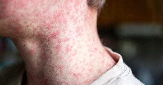 South Carolina confirms 138 cases of measles amid outbreak