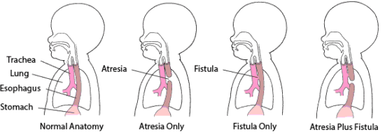 Esophageal Atresia and Tracheoesophageal Fistula – Children’s Health Issues