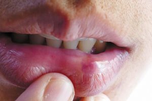 Burning mouth syndrome: The scorching reality
