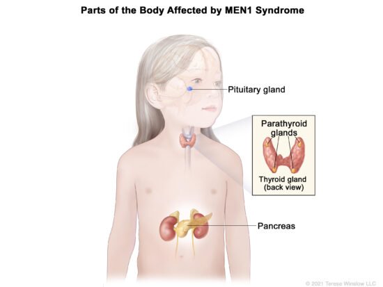 Childhood MEN1 Syndrome – NCI