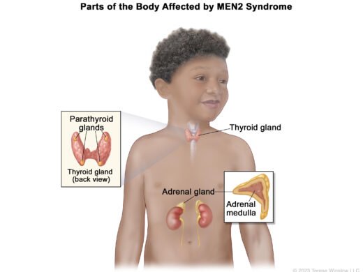 Childhood MEN2 Syndrome – NCI