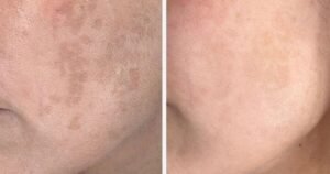 ‘Zombie cells’ trigger dark spots but this serum works to stop them