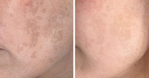 ‘Zombie cells’ trigger dark spots but this serum works to stop them