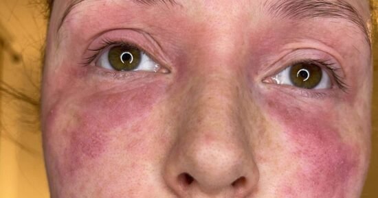 Mum ‘gets her life back’ with ‘simple treatment’ for severe eczema