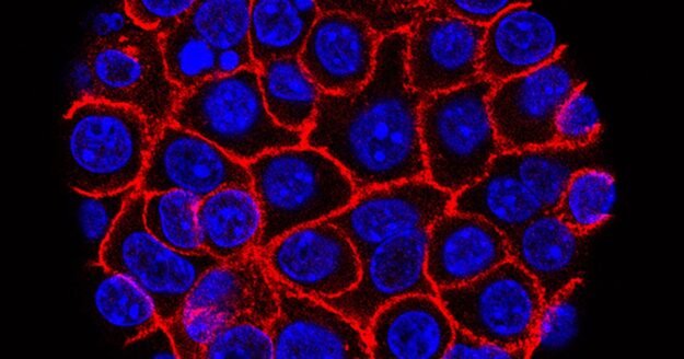 New drug nearly doubles survival rates in some pancreatic cancer patients, study says