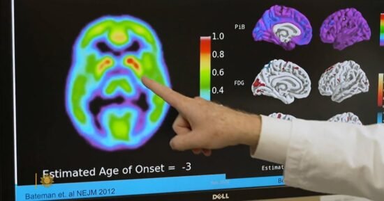 Alzheimer’s blood test may predict who’s likely to develop symptoms in 5 to10 years