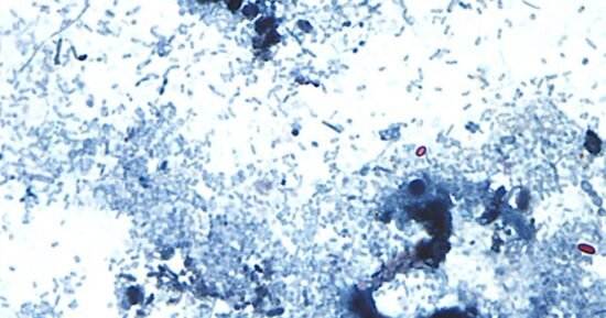Cyclospora cases have been reported in several states. What to know about the diarrhea-causing parasite.