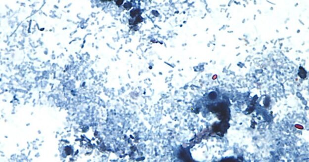 Cyclospora cases have been reported in several states. What to know about the diarrhea-causing parasite.