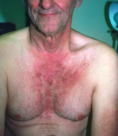 Idiopathic Inflammatory Myopathies – Bone, Joint, and Muscle Disorders