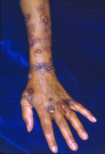 Bullous Pemphigoid – Skin Disorders