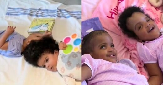 Doctors successfully separate twin girls conjoined at the head