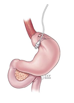 Adjustable Gastric Band – American Society for Metabolic and Bariatric Surgery