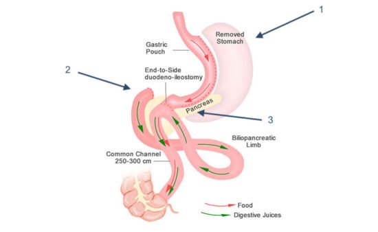Single Anastomosis Duodeno-Ileal Bypass with Sleeve Gastrectomy