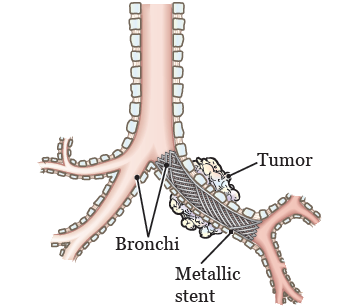 Tracheal or Bronchial Stent Placement