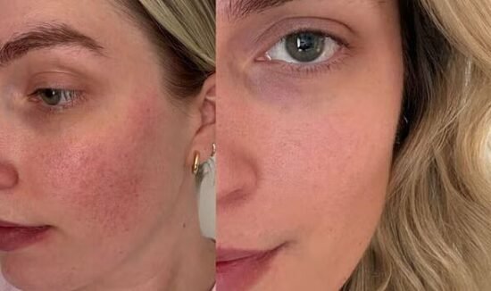 I used a bespoke £35 face cream and it smoothed skin and calmed redness within weeks
