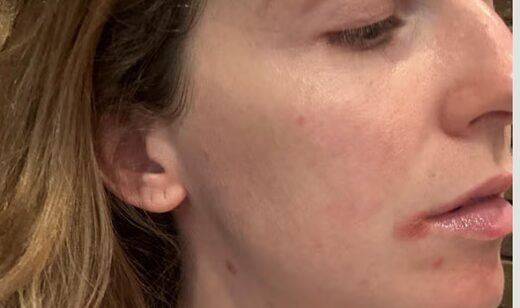Bride 'couldn't kiss at wedding' after cold sores – but finds £10 'literal holy grail'
